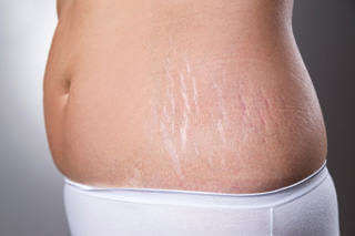 Stretch-Marks-on-Sides